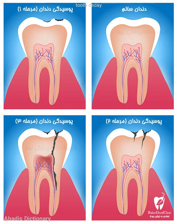 tooth decay